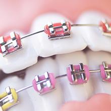 Dientes con brackets con cauchos de colores