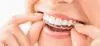 Persona sonriendo colocandose su Invisalign